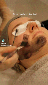 Carbon laser facial to treat hyperpigmentation